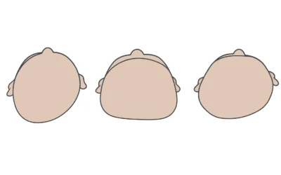 Plagiocéphalie du nourrisson : faut-il s’inquiéter d’un crâne plat ?